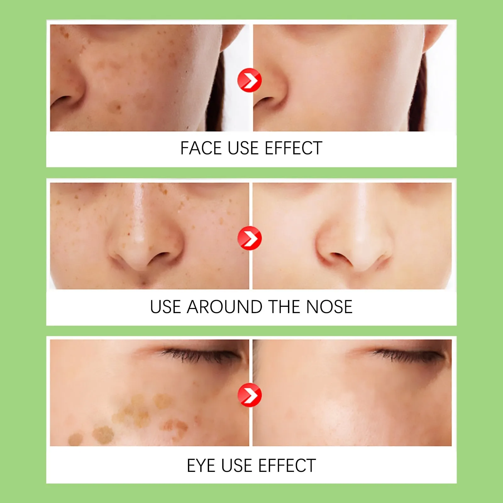 Whitening Freckles Cream Remove Melasma Dark Spot Lightening Melanin Brightening Melasma Remover Moisturize Anti-aging Face Care