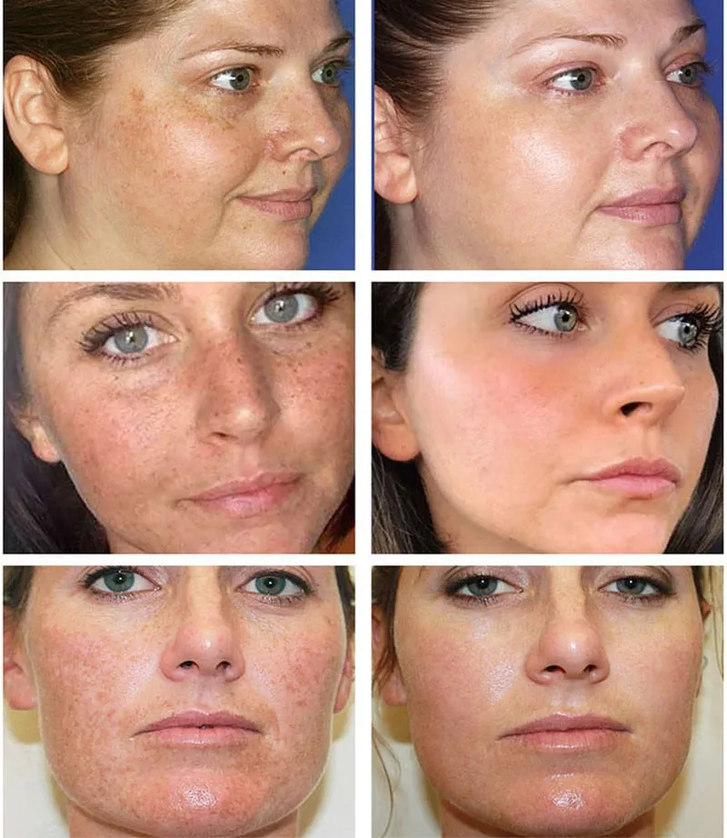 Whitening Freckles Cream Remove Melasma Dark Spot Lightening Melanin Brightening Melasma Remover Moisturize Anti-aging Face Care